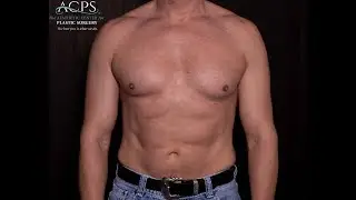 7 Years Post-Op Ab Etching