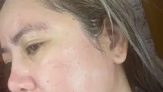 My First Neogen Plasma Treatment (Medically Aesthetically You)