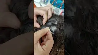 Beijing Massage Vocational Skill Training School. Обучение иглоукалывание лица и головы.