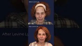 Deep Plane Facelift & Laser Skin Resurfacing in NYC