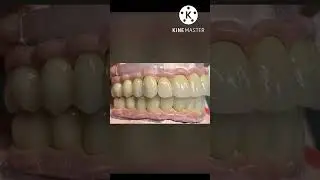 SAVING TEETH#shorts#new #happy#smoking#crown#rct#cleaning#smile#perfect#patient#trendingshorts#teeth