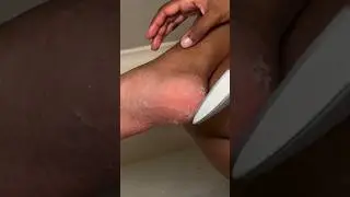 Как вылечить трещины на ногах 👣