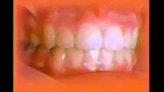 Rocke Ortho Teeth movement