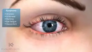LipiFlow Dry Eye Treatment Educational Video from Kugler Vision