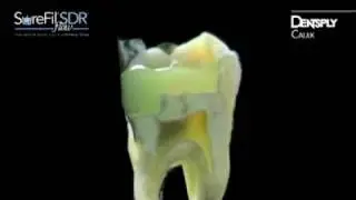 DENTSPLY Caulk's SureFil&reg; SDR&trade; flow