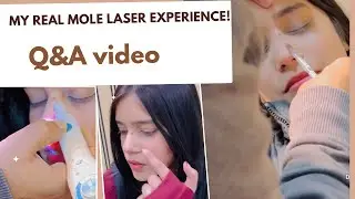 My Laser Mole Removal Experience | RESULTS ? COST? PAIN? SCAR CREAM? Q&A video  #laser #mole