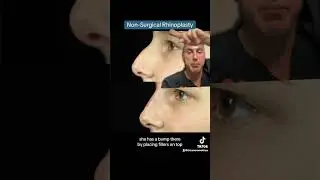 Non-Surgical Rhinoplasty