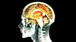 Una Mujer Bebi&oacute; &ldquo;Per&oacute;xido De Hidr&oacute;geno De Grado Alimenticio Al 35%&rdquo;. Esto Le Ocurri&oacute; A Su Cerebro.