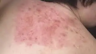 Microneedling to diminish back acne scarring!