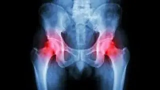 Dr. Carl Freeman Explains Hip Labrum Tears