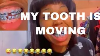 MY TOOTH IS MOVING..(POWER CHAIN,PAIN&hellip; 3 MONTHS BRACES UPDATE  PT2