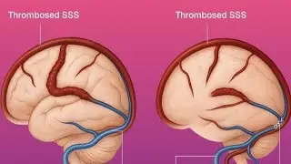 Zerebrale Venenthrombose (CVT)