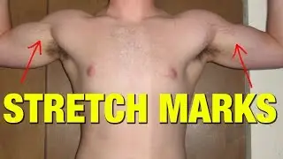 How to Remove Stretch Marks?