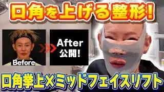 【整形】口角を上げる整形！まえしょー先生オペ当日