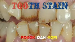 Scaling and Tooth Stain Removing / Pembersihan Noda Kopi dan Rokok