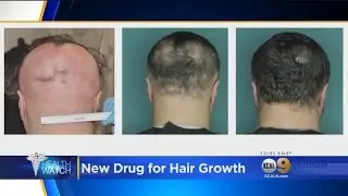 FDA Approves Hair Loss Drug