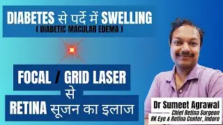 EYE INJECTIONS की ज़रुरत हो जाएगी कम ! जानिये RETINA के FOCAL / GRID LASER के बारे में l
