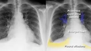 X-ray of the Chest for Pleural Effusion ; Definition, Characteristics and Diagnosis Uses