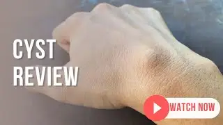 Cyst Review @ DTC skin clinic, Dr. Rohit Goel M.D. GIADA