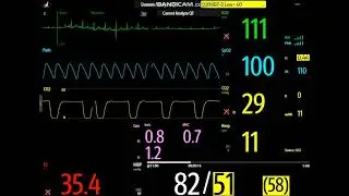 Hypotension and Bradycardia During Feline TECA Anesthesia: Glycopyrrolate Response in Real Time