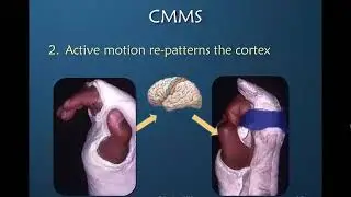 Nuances of Mobilizing the Stiff Hand: Part 7 of 9: Casting Motion to Mobilize Stiffness (CMMS)
