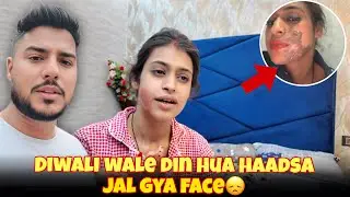 Diwali Wale Din Hua Haadsa Jal Gya Face 😣🙁