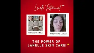 See Amazing Lanelle Skin Care Results on Acne or Pimple Treatment Solutions Lanelle Milanie Torralba