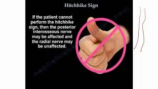 Common Nerve Conditions of the Upper Extremity