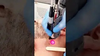 Laser Hair Removal by Dr Sara El Hadi - Dr Khaled Al Nuaimi Specialized Clinic