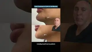 Laser Treatment of Cafe Au Lait Macules