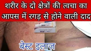 Tinea cruris ya jauk ringworm disease best treatment,causes, symptoms। Tinea daad ka beat elaj,karan