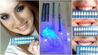 Affordable At Home Teeth Whitening Kit | Smile Sciences