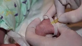 How to insert a cannula into a tricky vein (neonatal procedural skills ) part 2