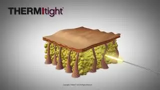 THERMItight Skin Tightening Treatment at Magnolia Plastic Surgery Tampa/Wesley Chapel
