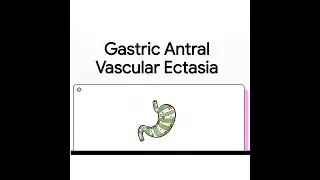 Gastric Antral Vascular Ectasia (GAVE) | Pathophysiology, Diagnosis & Management
