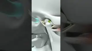 Звон в ушах &mdash; это #тиннитус или #ВНЧС?