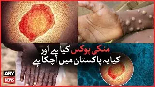 What is Monkeypox and how dangerous is it?
