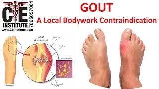 Gout: A Massage Therapy & Bodywork Contraindication