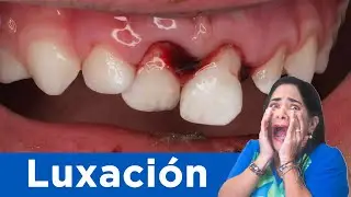 ⚠️ Luxación dental!