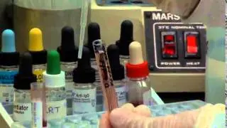 Washing patient cells and 5% prep video
