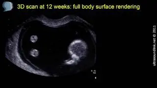 3D scan at 12 weeks: fetal body and legs