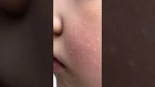 What is Milia? | Skin Type Solutions