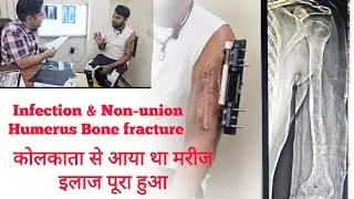 Full recovery Humerus Bone fracture infection  & non-union treatment with LRS frame #ilizarovsurgery