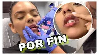 LIP FILLERS - INYECCIONES DE LABIOS CON ACIDO HIALURONICO MI EXPERIENCIA