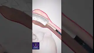 Aortic Stent Grafts -Thoracic Endovascular Aortic Repair #shorts