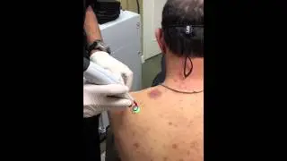 Treating spider angiomas, telangiectasias, port wine stain, hemangiomas with Vbeam perfecta