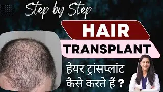 💹 हेयर ट्रांसप्लांट कैसे किया जाता है?👩🏿‍🦲 Hair Transplant Procedure Step by Step in Hindi | #HT