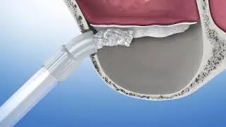 Greffe osseuse sinus - Implant