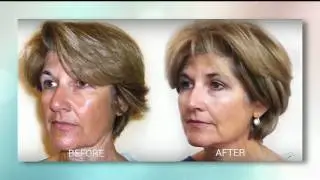 CoolBody Contours offers Silhouette Instalift to look years younger