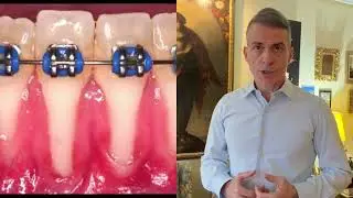 RISKS OF ORTHODONTIC THERAPY